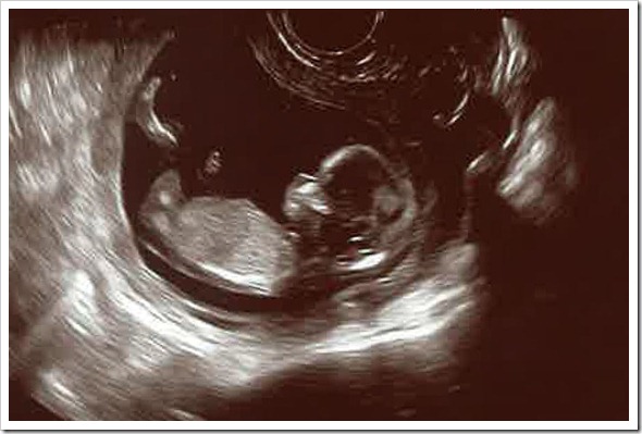 Ultrasound