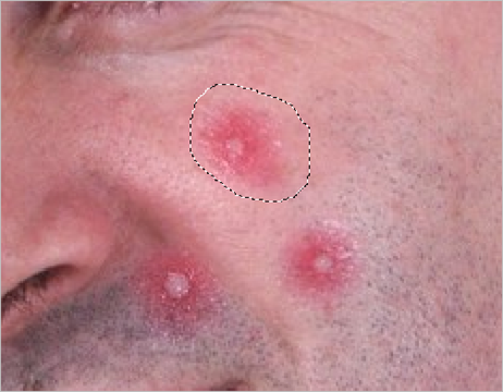 Select a blemish with the Patch Tool Select-a-blemish-with-the-Patch-Tool