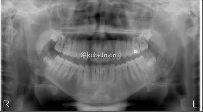 ameloblastoma