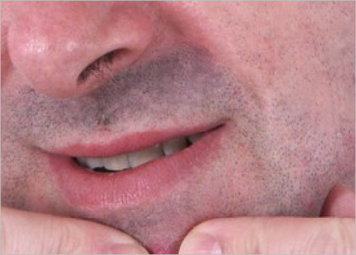 Removing acne in Photoshop Removing-acne-in-Photoshop