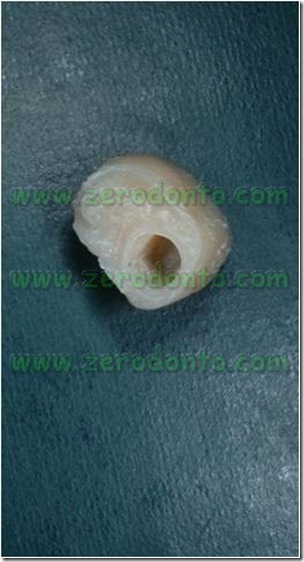Capsula provvisoria