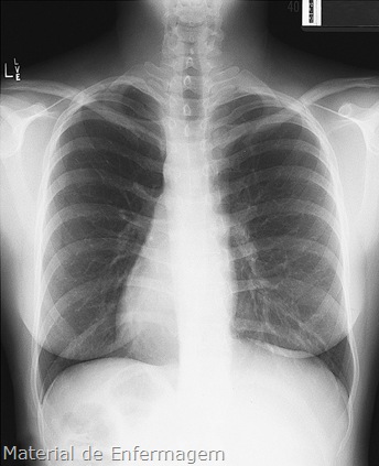 X-Ray