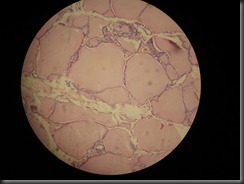 Colloid goitre high resolution histology slide tsnaps