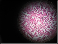 Colorectal Carcimoma- high resolution histology slide tsnaps