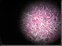 Colorectal Carcimoma- high resolution histology slide tsnaps Colorectal Carcimoma- high resolution histology slide tsnaps