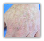Skin Cancer Topical Treatment Natural Skin Cancer Topical Treatment Natural