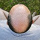 featured-hair-loss