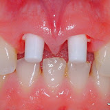 Implantes CeraRoot