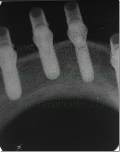 radiografia ednorale impianti straumann