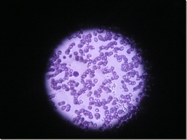 aplastic anemia slide under microscope