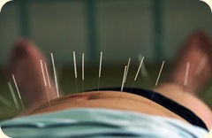 acupuntura-adelgazar
