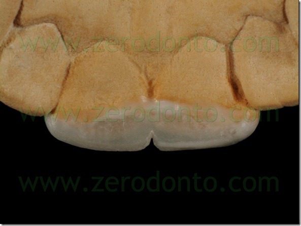 38 faccette usura incisale