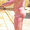 PlaquePsoriasis3.jpg