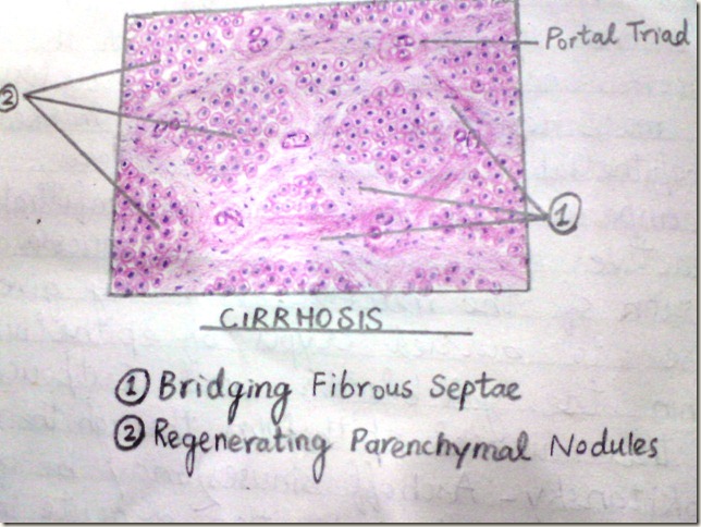 cirrhosis detailed histopathology diagram
