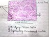 Diagram Of Liver Cirrhosis - 1 212 Cirrhosis Illustrations Clip Art Istock
