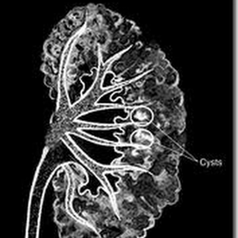Medullary Sponge Kidney, Clinical Features, Investigations and Treatment