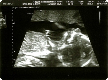 Twin A Baby Girl 18 weeks