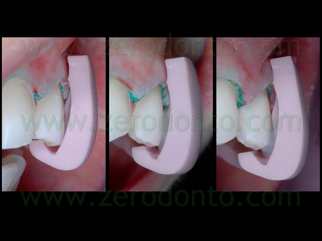 [68-rifinitura-preparazioni-veneers-c.jpg]