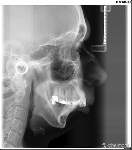 mandíbula e lesão 2 tele