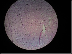 giant cell tumor high resolution histology slide tsnaps giant cell tumor high resolution histology slide tsnaps