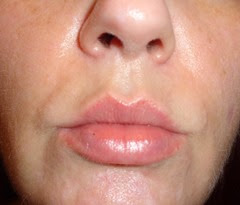 after SkinPhD_lips