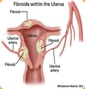 Fibroids