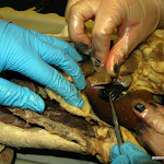gall_bladder_probe.JPG