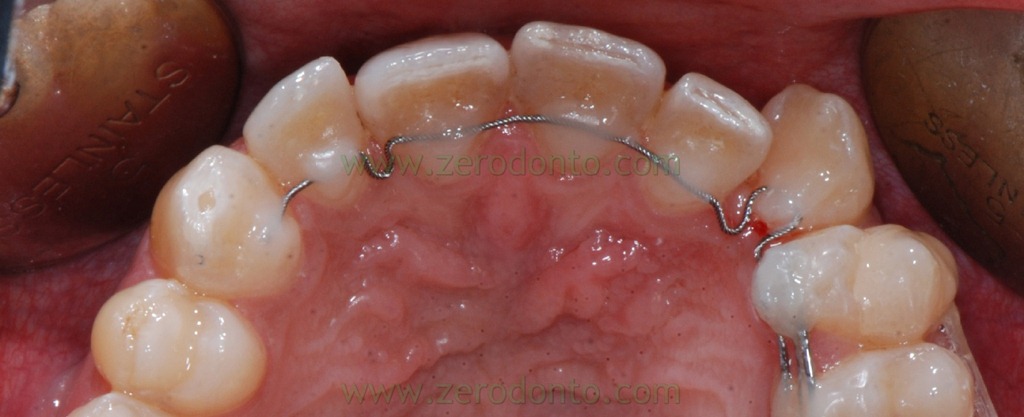 [22%2520apparecchio%2520denti%255B5%255D.jpg]