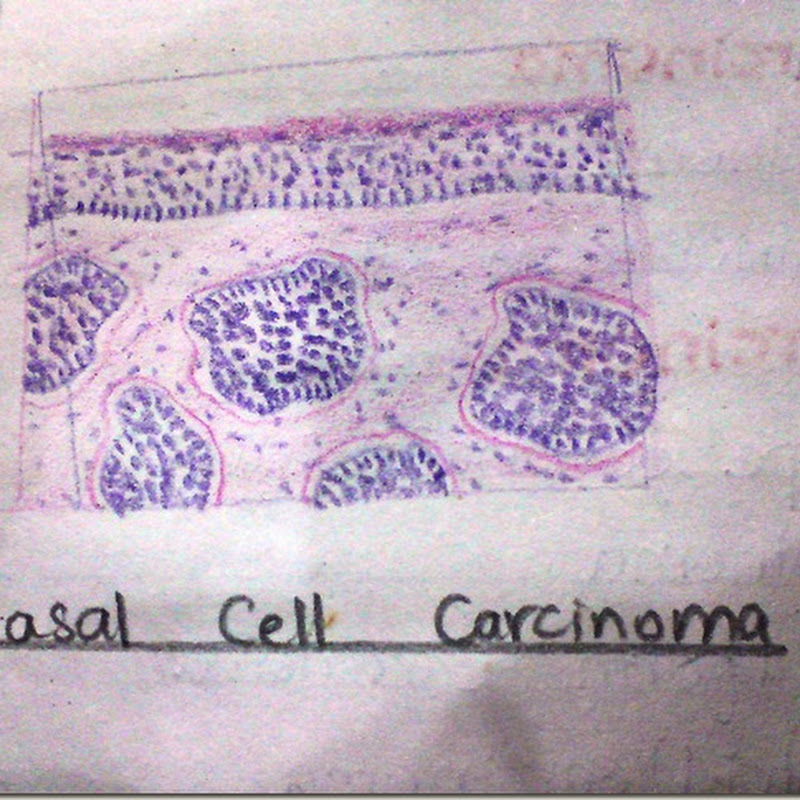 Histology Slides Database Basal Cell Carcinoma Histopathology