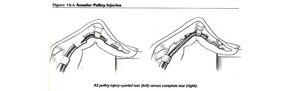 injury-a2-finger-anatomy-2.jpg Injury a2 finger anatomy 2