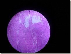 leiomyoma photograph of histology slide