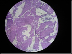 basal cell carcinoma  high resolution histology slide tsnaps