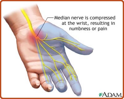 RSI Wrist Hand Problems
