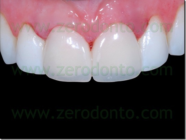 78 temporary veneers