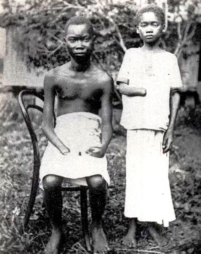[Amputated_Congolese_youth%255B6%255D.jpg]