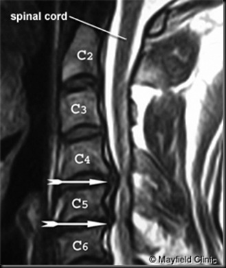 Sagittal cervical MRI of disc herniations at C4 and C5 disc spaces.