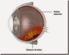 distacco retinico