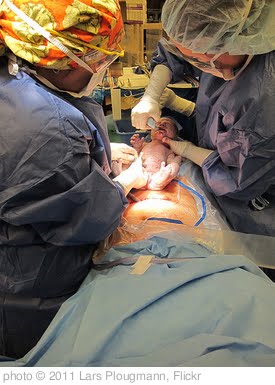 lapszemle császármetszés