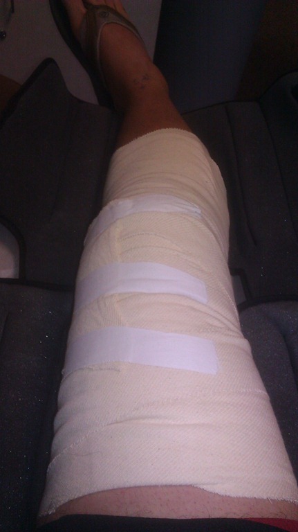 [acl_post_op_bandage%255B3%255D.jpg]