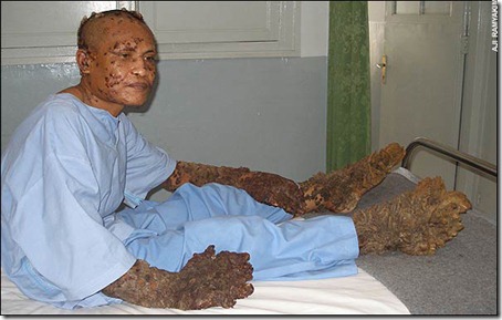 hombre arbol antes y despues (5)