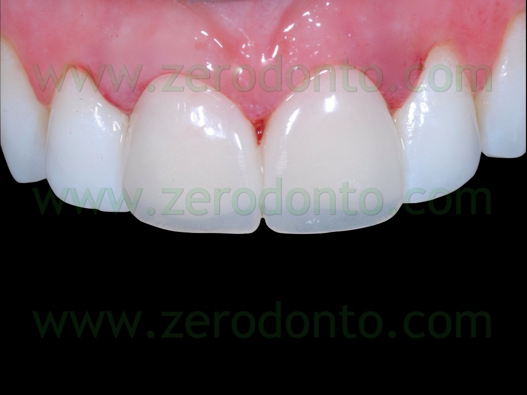 [78-temporary-veneers3.jpg]