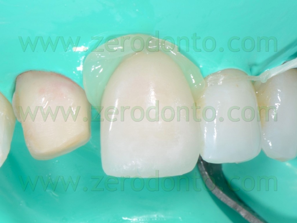 [115-rimozione-cemento-veneers2.jpg]