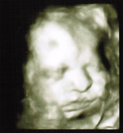 3D ultrasound face 31 weeks