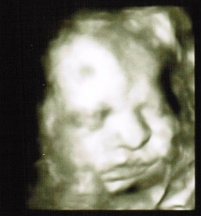 3D ultrasound face 31 weeks 3D ultrasound face 31 weeks