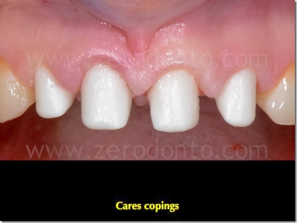 A Cares coping A Cares coping