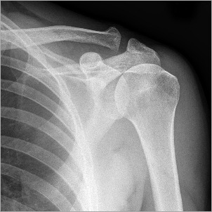 Shoulder X-Ray
