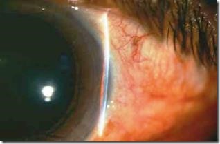 Glaucoma de angulo cerrado
