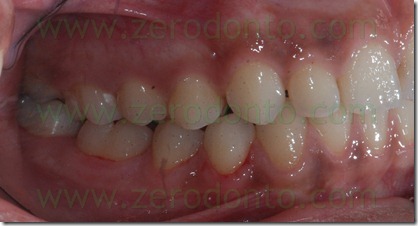 38 prima classe dentaria