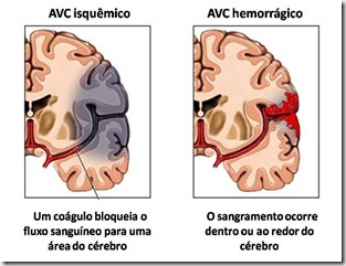 avc_tipos