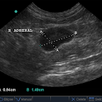 Right Adrenal Hyperplasia in a cat